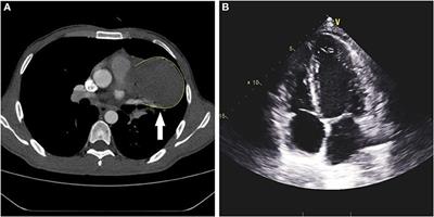 Case Report: Not a Mediastinal Mass! a Ruptured Giant Coronary Aneurysm That Occurred in a Young Man